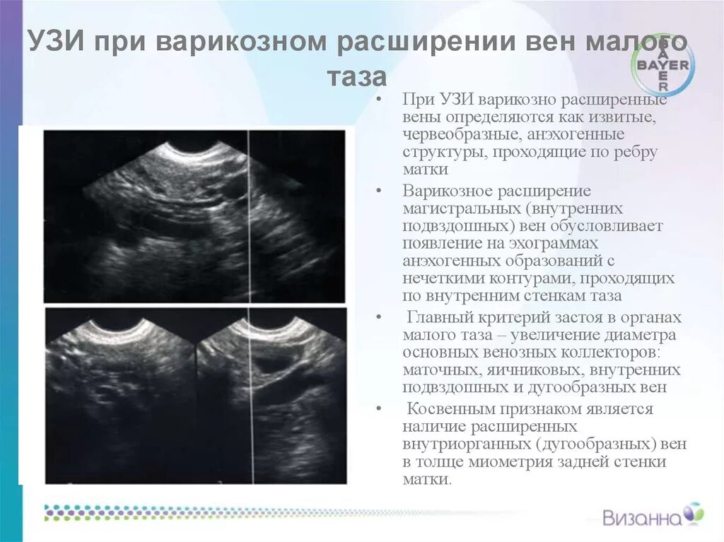 Варикозное расширение вен малого таза по УЗИ заключение. Варикозное расширение вен малого таза по УЗИ. Расширение вен в Малом тазу на УЗИ. Расширение вен малого таза УЗИ заключение. Что значит расширенная матка