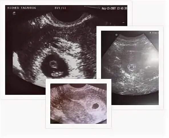 Как выглядит узи на 6 неделе. УЗИ 6 недель беременности фото. 6 Недель беременности фото двойня.