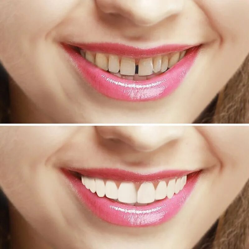 Аккуратнее зубы. Виниры-элайнеры Snap-on smile. Cъемные виниры perfect smile Veneer (Snap on smile). Красивые зубы.