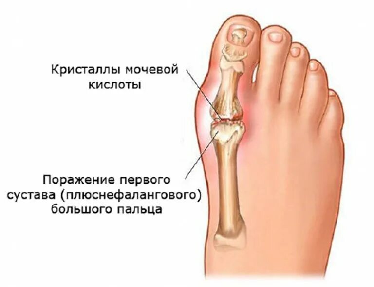 Болит ступня большой палец. Плюснефаланговый сустав подагра. Первый плюснефаланговый сустав подагра. Подагра 1 плюснефалангового сустава. Сустав большого пальца ноги.