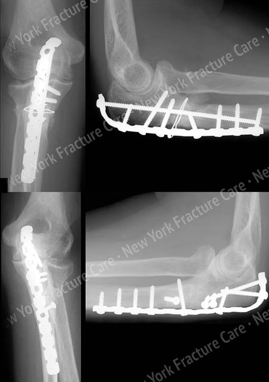 перелом локтевого отростка рентген. остеосинтез дмэ лучевой кости. остеосинтез локтевого сустава. остеосинтез локтевого отростка пластиной. перелом галеацци остеосинтез.