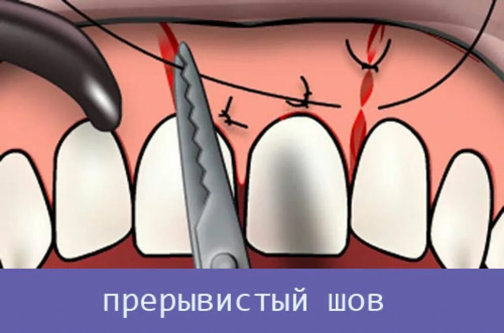 Удалить зуб последствие. Наложение шва на Десну.