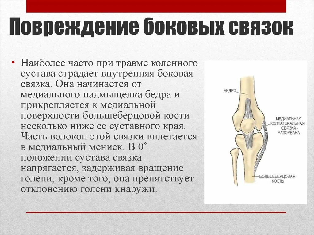 Повреждения внутренней боковой связки колена. Внутренняя боковая связка колена разрыв лечение. Травмы связок коленного сустава. Повреждение боковых связок коленного сустава.