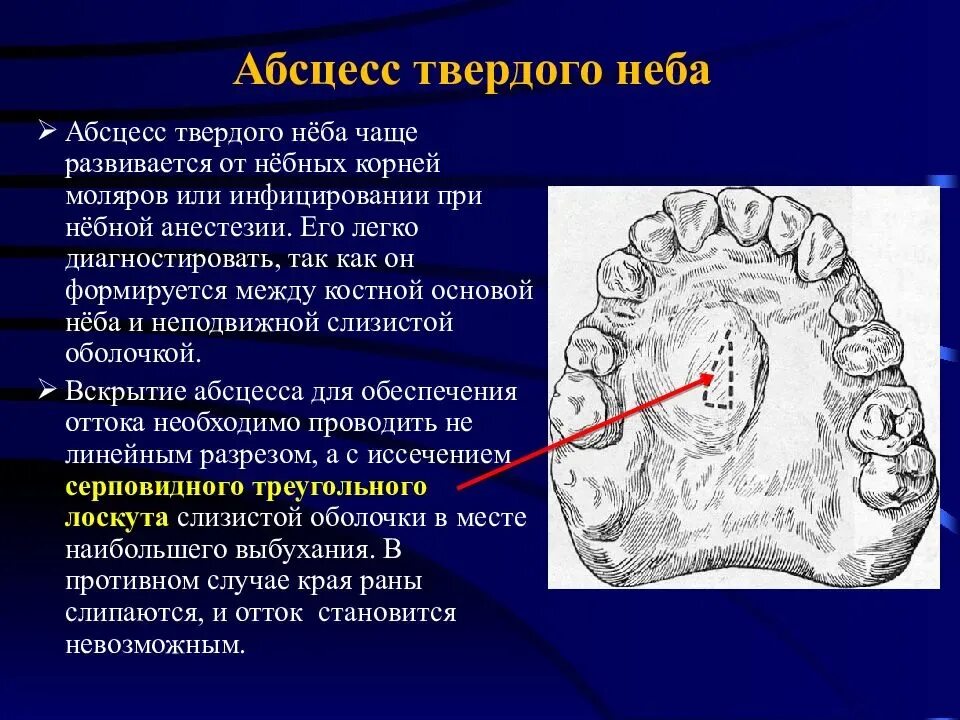 Абсцесс на небе фото