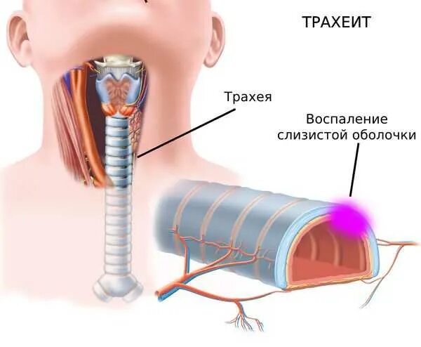 Отек при трахеите