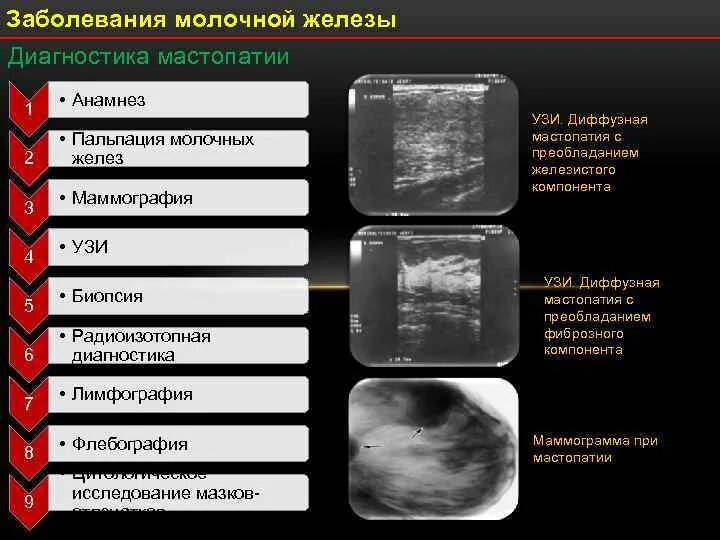 Диффузно фиброзно кистозные изменения. Диффузионная фиброзно-кистозная мастопатия. диагностика заболеваний молочной железы. мастопатия диагностика. методы обследования молочных желез.