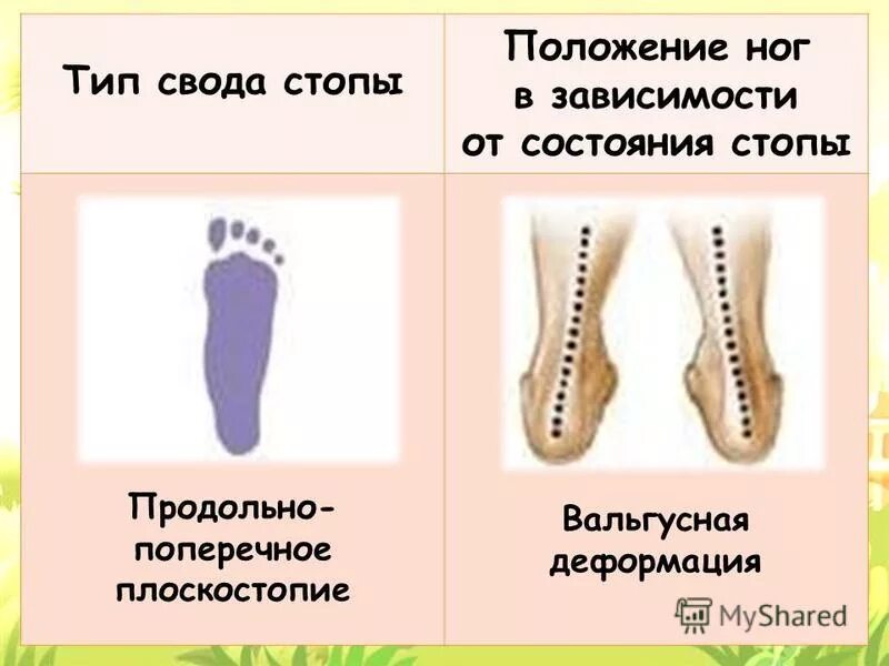 варусная деформация коленных суставов. положение ног у детей. плоскостопие поперечного свода стопы. правильная постановка стопы. положение ног у детей.