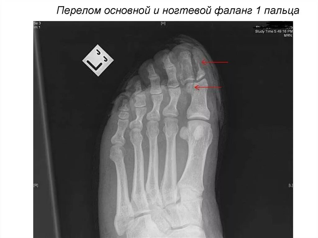 краевой перелом средней фаланги 5 пальца. оскольчатый перелом основной фаланги 1 пальца руки. краевой перелом ногтевой фаланги пальца. перелом ногтевой фаланги 1 пальца кисти. перелом диафиза проксимальной фаланги.