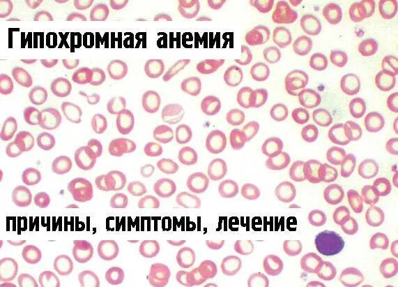 Гипохромная анемия. Гипохромная микроцитарная анемия. Гипохромная анемия симптомы. Гипохромная анемия микроцитарная анемия.