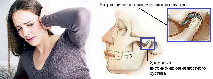 Щелкает челюсть при открытии рта что делать. Гипермобильность суставов ВНЧС. Челюстью(дисфункция ВНЧС). Дисфункциональный синдром ВНЧС.