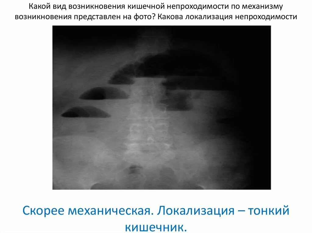 Определение кишечной непроходимости