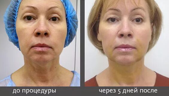 Сколько держатся нити. Aptos Excellence visage нитевой лифтинг. Аптос Light Lift Needle 2g. Нити Аптос визаж реабилитация.