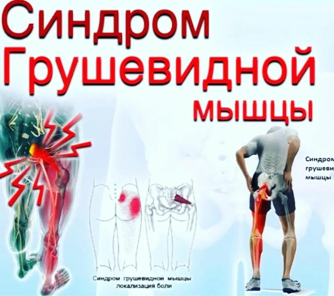 грушевидная мышца и седалищный нерв. синдром грушевидной мышцы симптомы упражнения. синдром грушевидной мышцы симптомы. воспаление грушевидной ягодичной мышцы. грушевидная мышца воспаление.