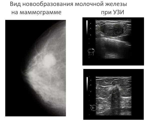 узи молочных желез рязань. ультразвуковая анатомия молочных желез. гиперплазия железистой ткани молочной железы на узи. ультразвуковое исследование молочной железы. ультразвук узи молочных желез.