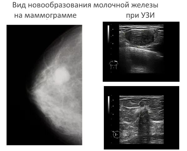 Чем маммография отличается от узи молочных желез