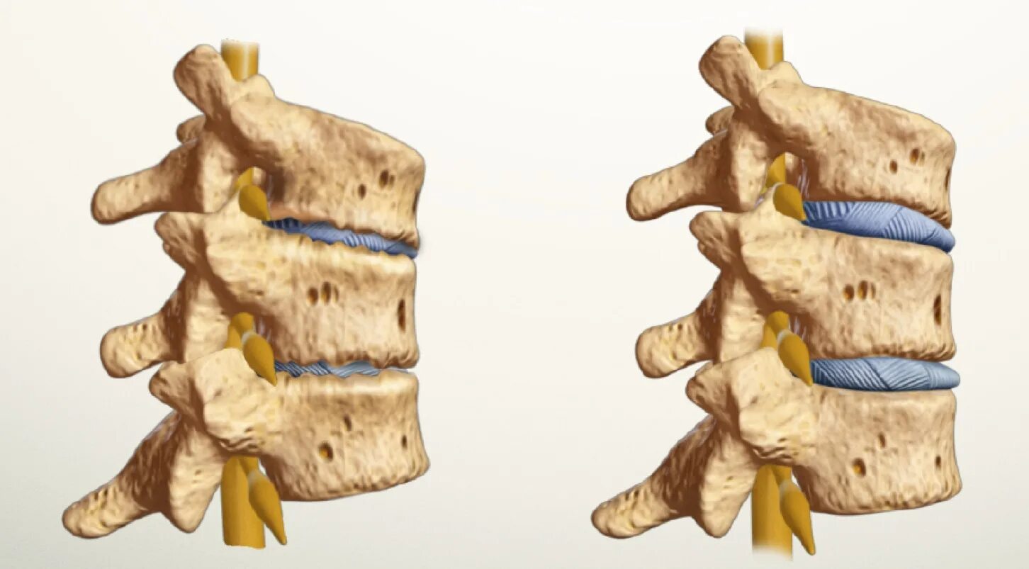 Спондилез l5. Грыжа Шморля l1 l3 позвонков. Грыжи Шморля межпозвонковых дисков. Шморля в грудном отделе позвоночника.