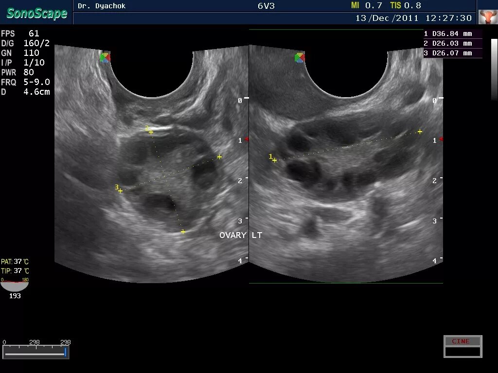 Климакс на узи. Поликистоз яичников УЗИ малого таза. Мультифолликулярный яичник УЗИ. Синдром поликистозных яичников УЗИ. УЗИ мультифолликулярных яичников и СПКЯ.