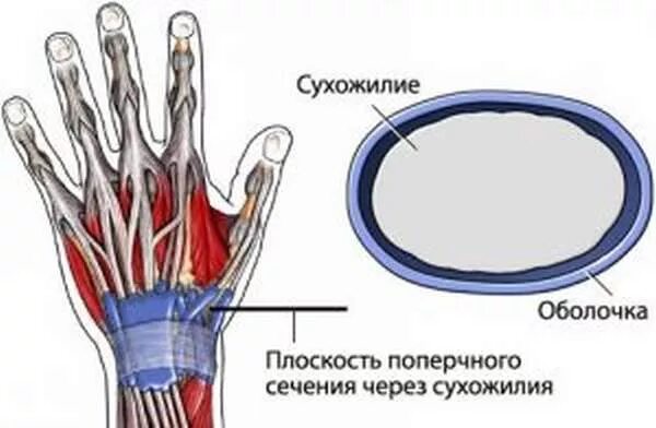 Как вылечить сухожилия