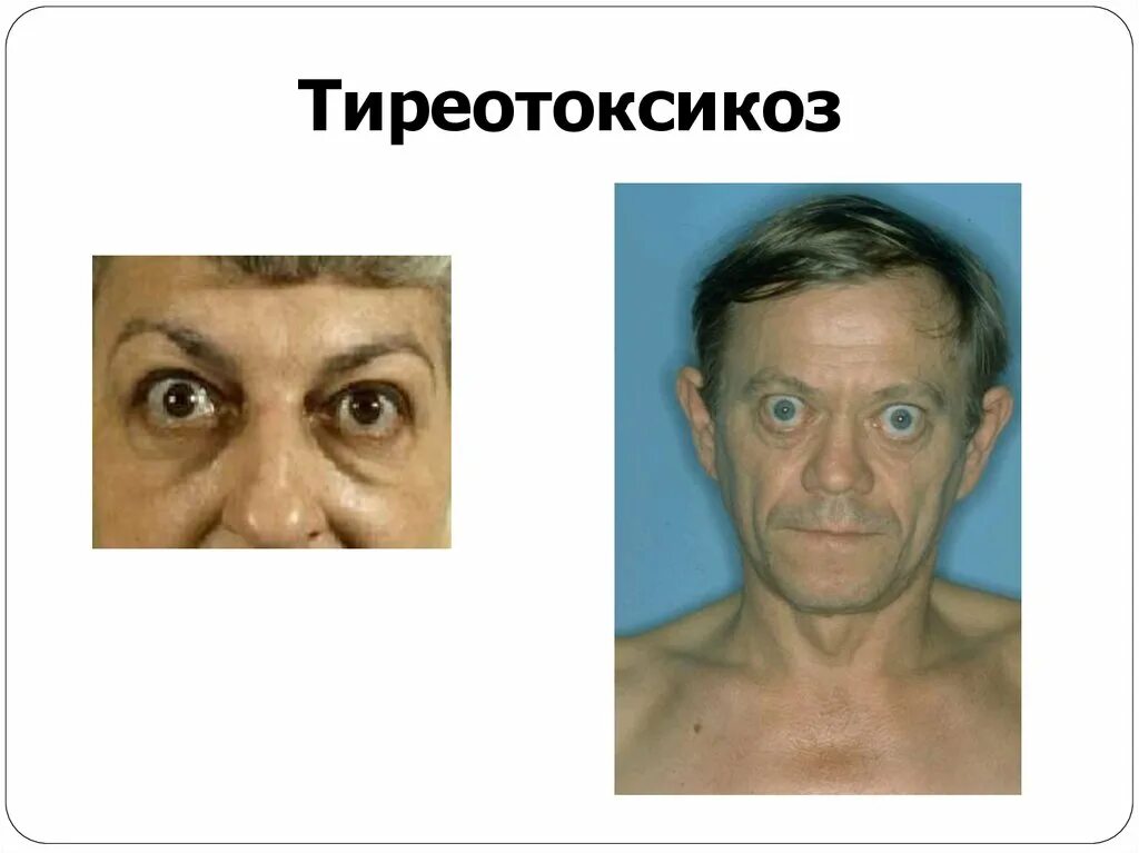 Тиреотоксикоз у взрослых. Больной тиреотоксикозом.