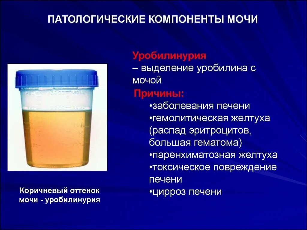 Вытекает моча почему. Моча больного гепатитом. Моча при циррозе печени цвет. Уробилин в моче цвет. Изменение цвета мочи.