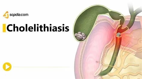 Cholelithiasis латынь