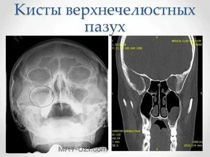 Киста в верхнечелюстной пазухе носа