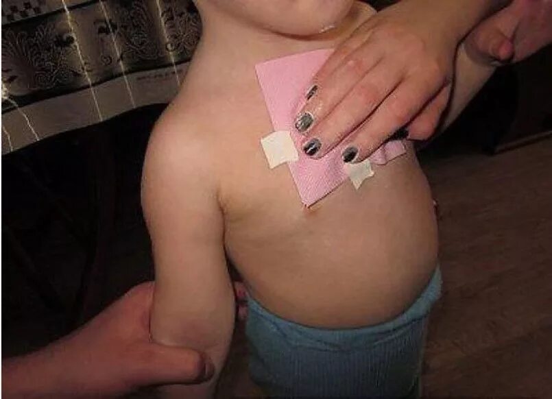 Компресс при бронхите ребенку. Компресс при бронхите ребенку. Лепёшка от кашля для детей. Компресс от кашля с горчицей. Дренажный массаж для детей при кашле.