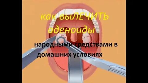 Аденоиды народные средства