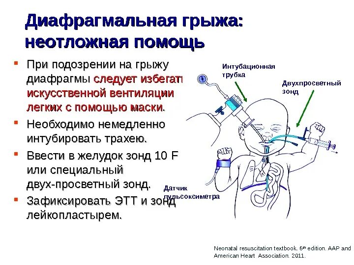 Причины диафрагмы
