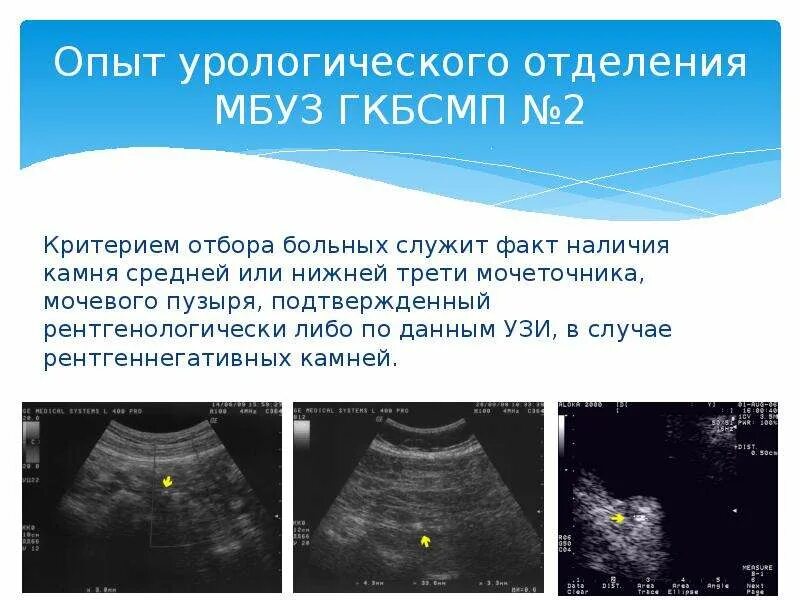 Камни в мочевом пузыре УЗИ. УЗИ мочевого пузыря Устье мочеточника. Камень в Устье мочеточника на УЗИ. Конкремент в Устье мочеточника УЗИ. Анализ мочеточника