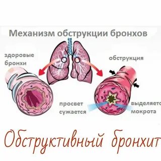 Бронхит абстрактный у ребенка