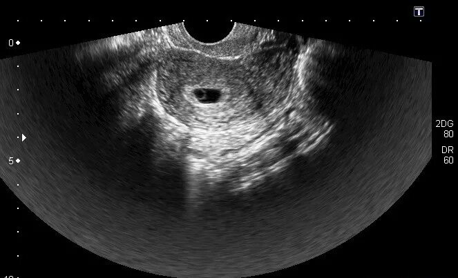 Эндометрий отслойка. Плодное яйцо на 6 неделе беременности УЗИ. Плодное яйцо 5 недель на УЗИ беременность 6. УЗИ 6 недель беременности плодное яйцо на УЗИ. Желточный мешок при беременности на УЗИ 5 недель.