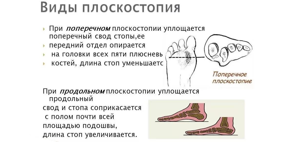Свод стопы лечение