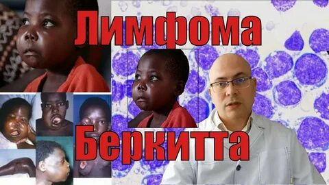 Лимфома 2020