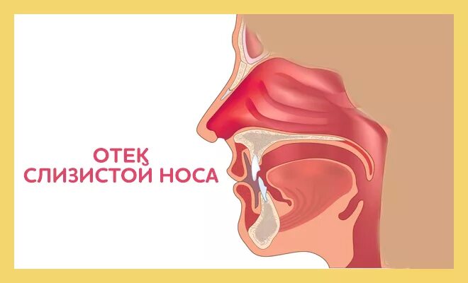 Заложенность носа отечность