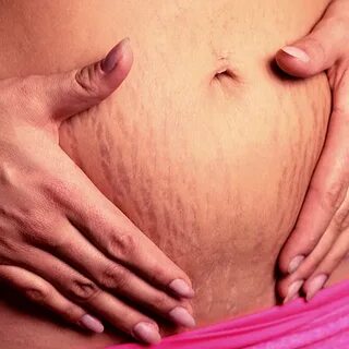 Как убрать растяжки на бедрах и ягодицах