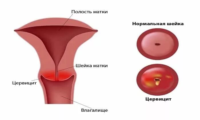 Хронический эндоцервицит что это. Цервицит и эндоцервицит. Гонококковый цервицит. Хронический цервицита ше.