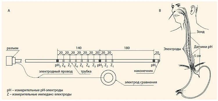 Импедансометрия пищевода. 24-Часовую РН- импедансометрию пищевода. Импеданс метрия пищевода. 24 Часовая PH импедансометрия пищевода. Схема установки зондов.