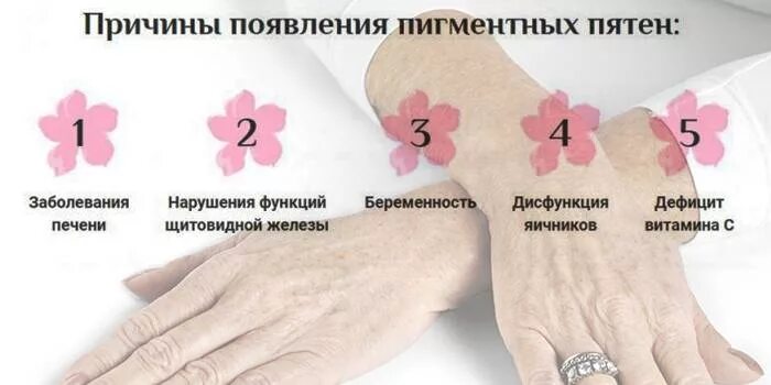 Возрастные пятна как избавиться. Возрастные пятна на теле. пигментные пятна на руках и ногах возрастные.