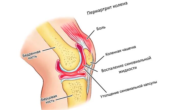 Болит под коленкой. Болит сухожилие под коленом. Болит под коленкой слева.