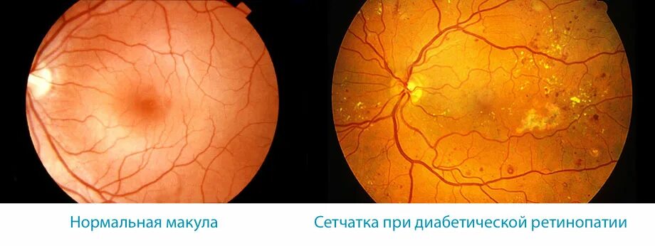 Диабет сетчатка. Диабетическая ретинопатия глазное дно. ретинопатия непролиферативная стадия. препролиферативная диабетическая ретинопатия клиника.