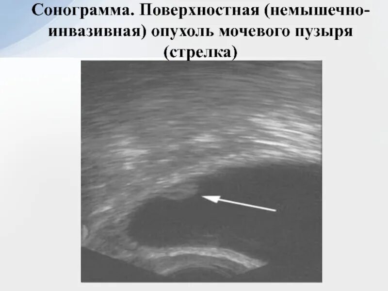 Мочевой рецидив. Опухоль поверхностный в мочевом пузыре. Опухоль мочевого пузыря сонограмма. Полипоз мочевого пузыря. Полип мочевого пузыря на УЗИ.