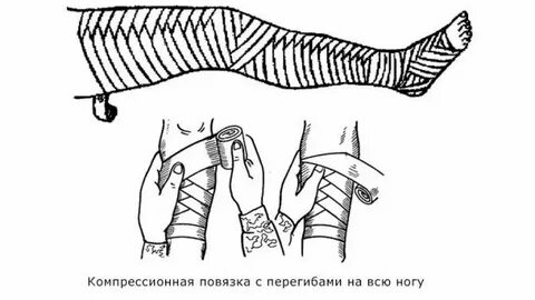 Наложение эластичных бинтов на конечности