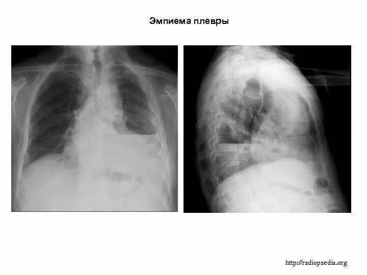 Эмпиема легкого. Острый Гнойный плеврит рентген. Гнойный плеврит эмпиема плевры. Острая эмпиема плевры рентген. Хроническая эмпиема плевры рентген.