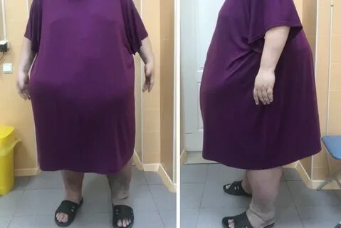 Операция желудка в ростове