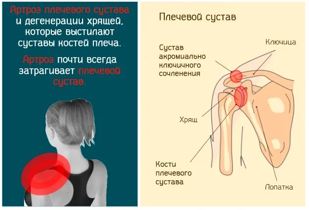 Ноющая боль в плече. Суставные хрящи плечевого сустава. Артроз лопаточно-плечевого сустава. Хпящь плечевого сустава. Плечелопаточный остеоартроз.