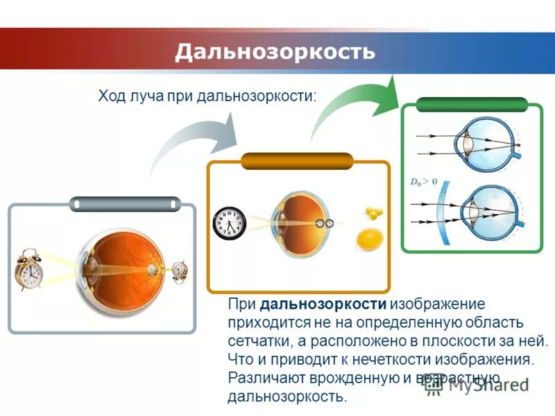 Дальнозоркость что делать. Дальнозоркость. Близорукость и дальнозоркость. Дальнозоркость сообщение. Дальнозоркость картинки.