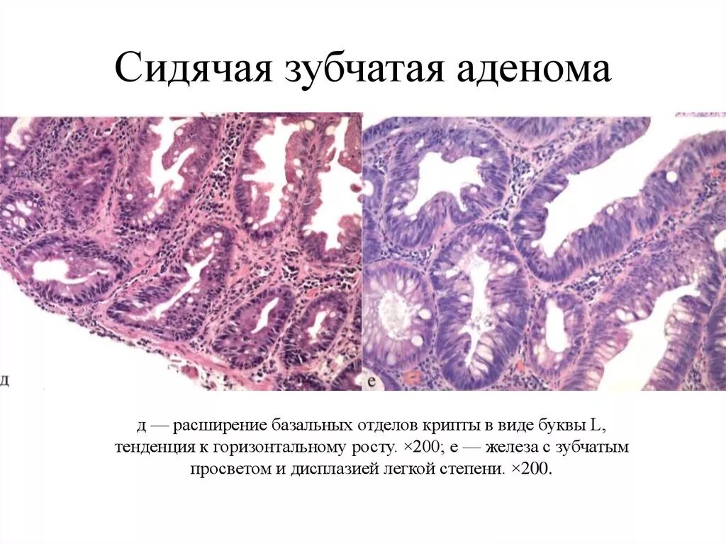 Тубулярная аденома толстой. Гиперпластический полип толстой кишки микропрепарат. Аденома кишечника гистология. Зубчатая аденома толстой кишки патанатомия. Зубчатая аденома толстой кишки.