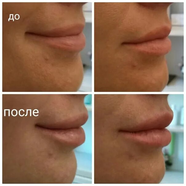 Как правильно разминать губы. Ювидерм 3 1мл. Juvederm Ultra 3 1 ml что это. Ювидерм 1 мл. Контурная пластика Ювидерм.