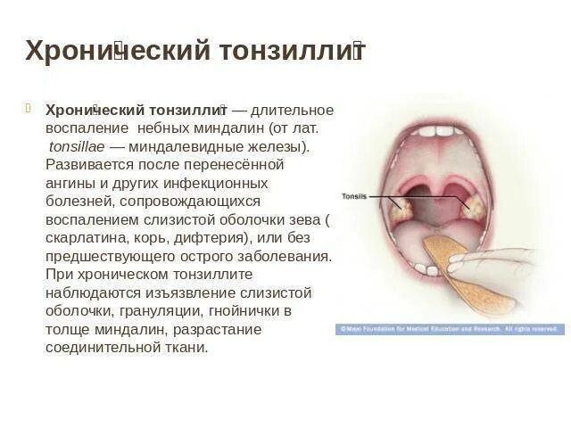 Воспалилась небная миндалина. Тонзиллит глоточной миндалины. Обострение хронического тонзиллита. Вид зева